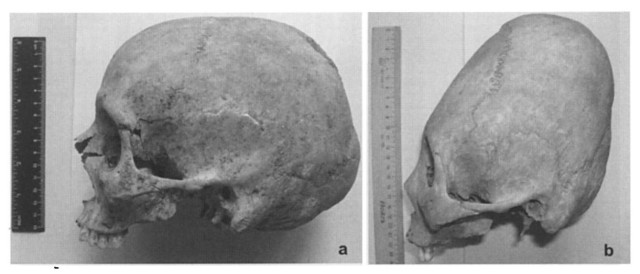 Vergleich eines normalen Schädels mit einem künstlich verformten, verlängerten Schädel. Beide stammen aus der Moskauer Sammlung. (Quelle: Arnold et al; 2008)